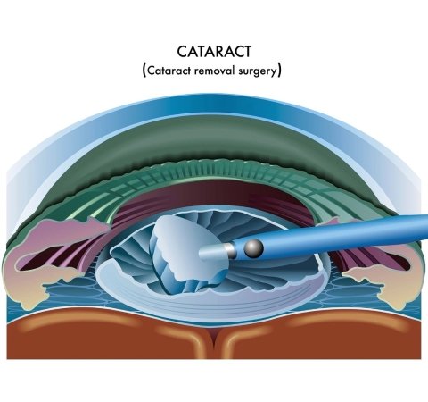cataract ayaan eye