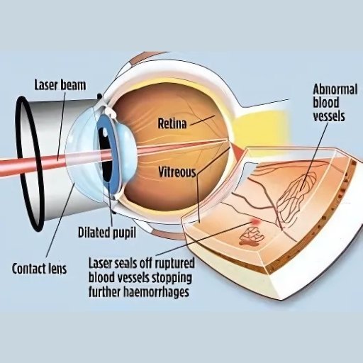 lasik treatment