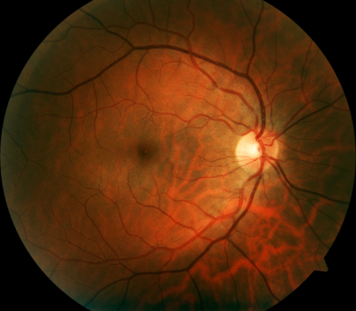 retina