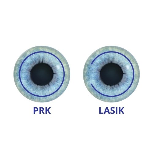 vision correction surgery
